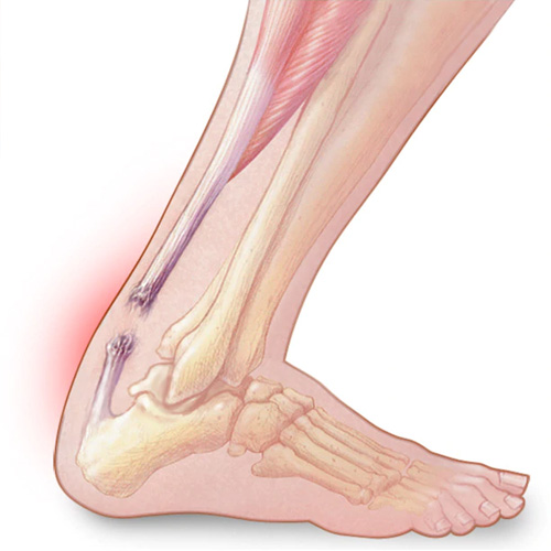 Achilles Tendonitis