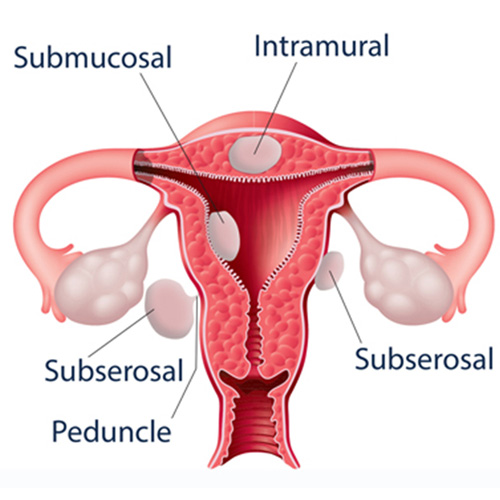 Fibroids