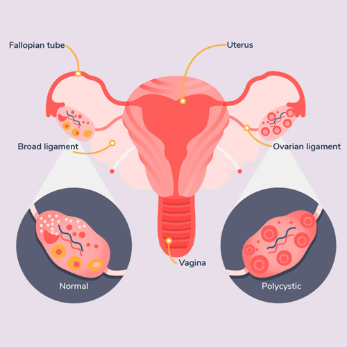 PCOS