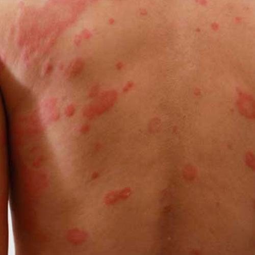 Urticaria